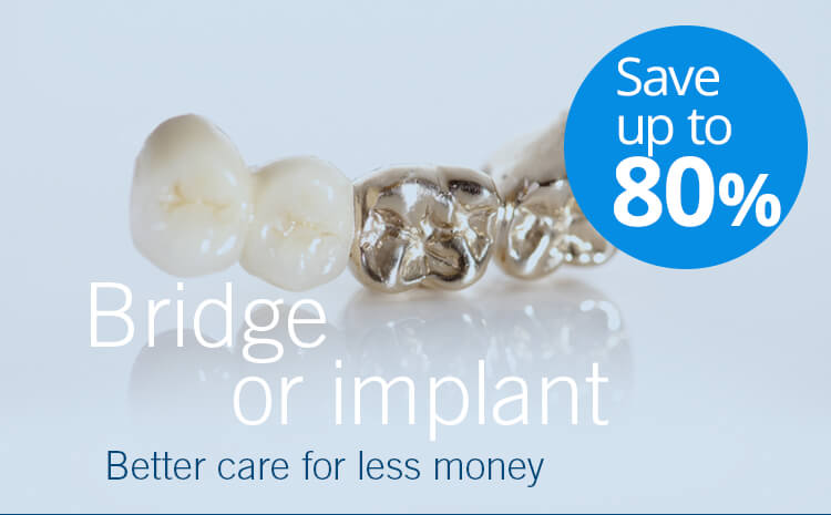 Bridge or implant, save up to 80%!