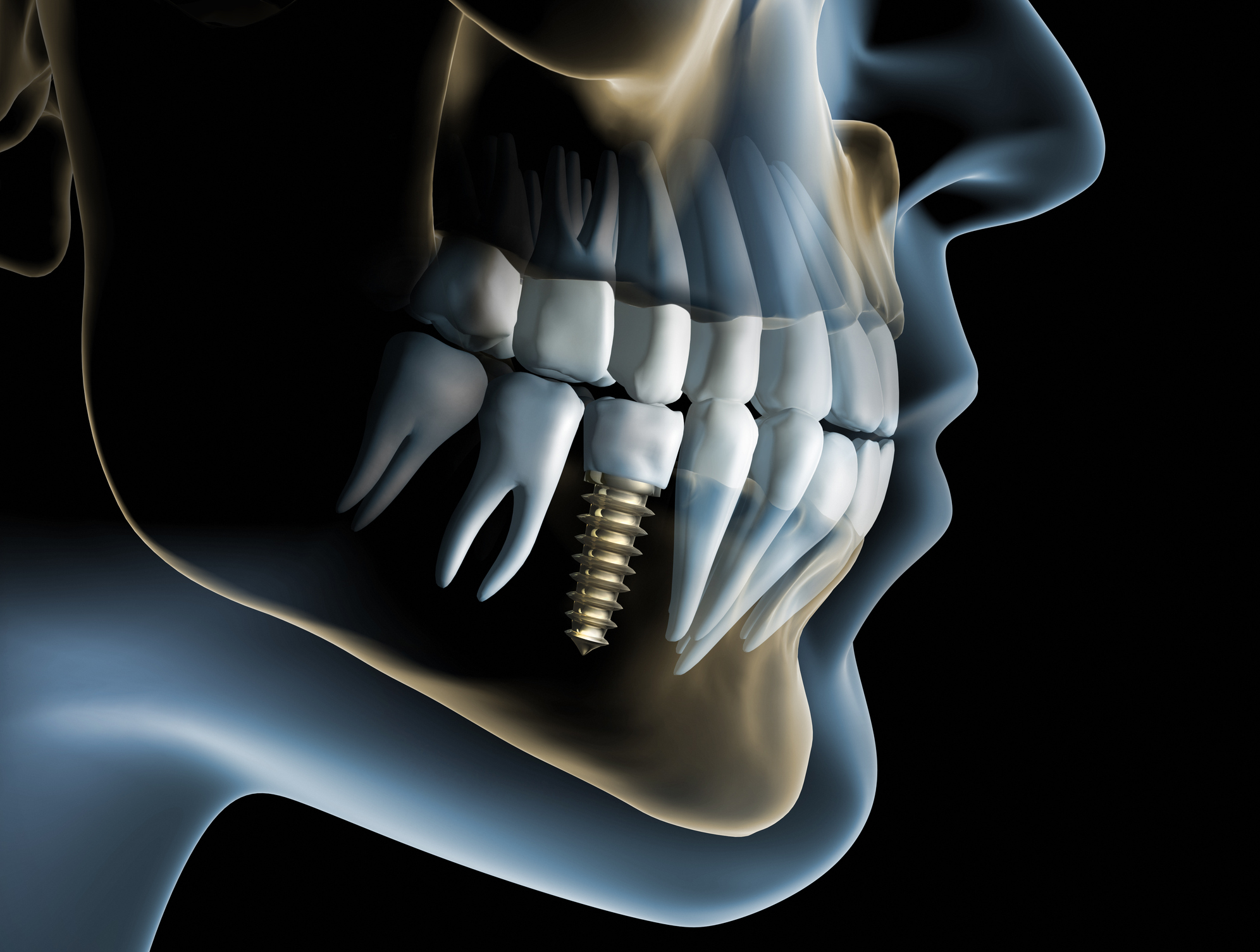 Röntgenansicht eines Kiefers mit Zahnimplantat – Vergleich zwischen Implantat und Zahnprothese als Zahnersatz